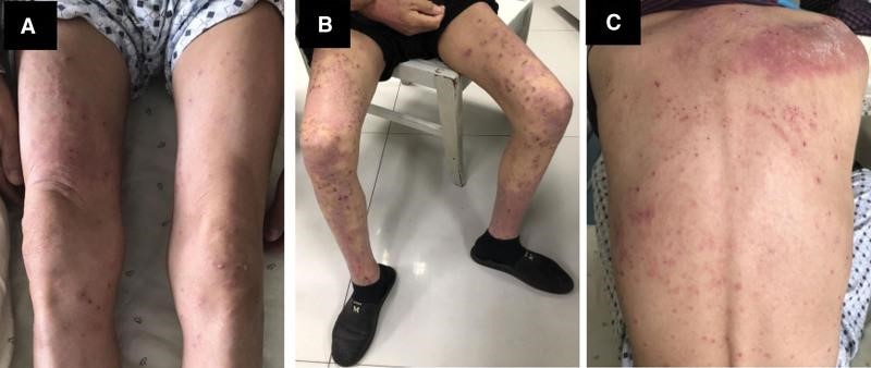 【佳学基因检测】基因检测鳞细胞肺癌EGFR突变伴PD-L1表达后的制定出帕博利珠单抗靶向药物治疗